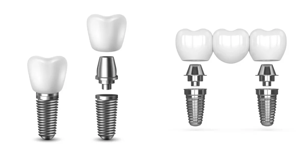 model of single tooth implant and multi-tooth implant bridge
