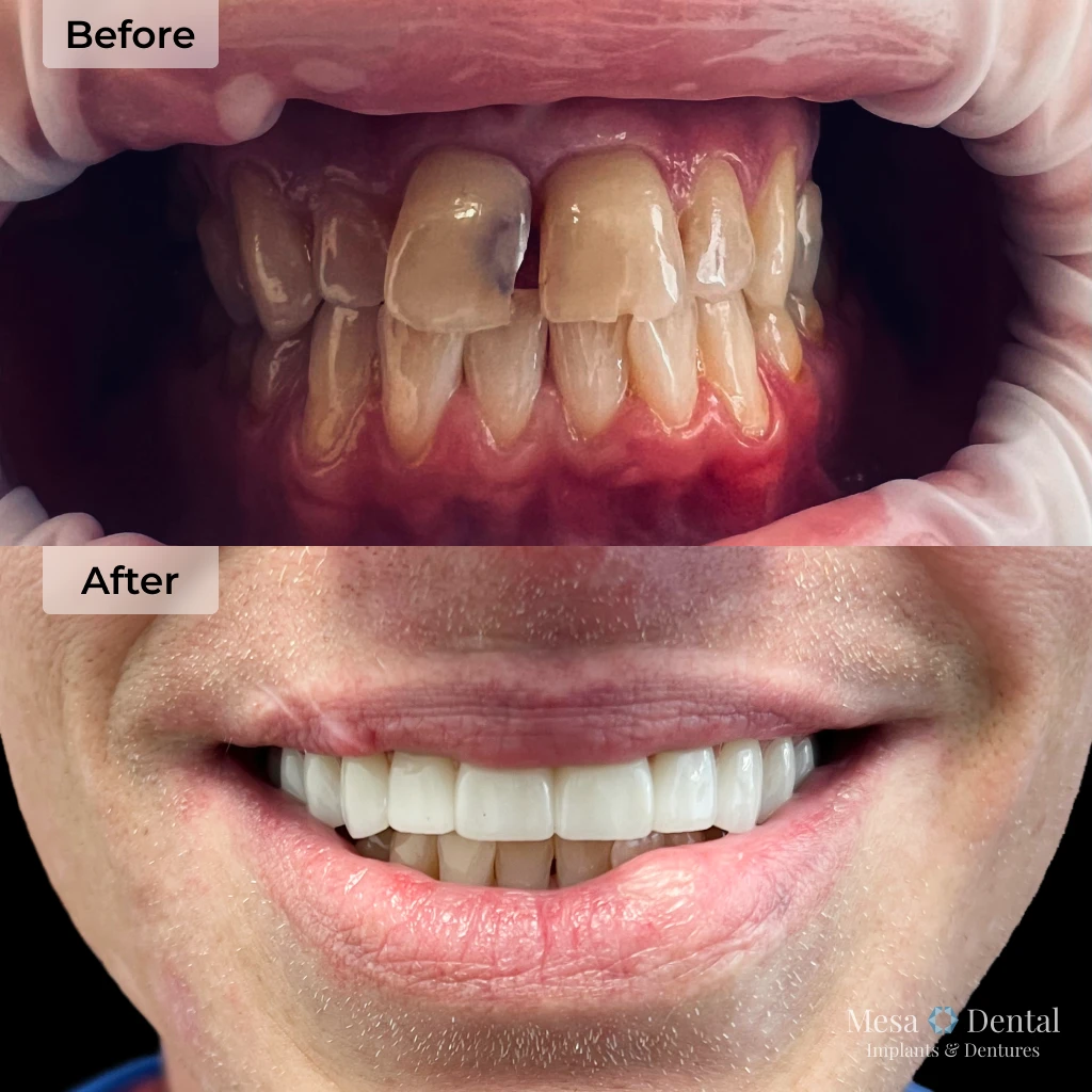 Alan before and after dental implants in Mesa, AZ