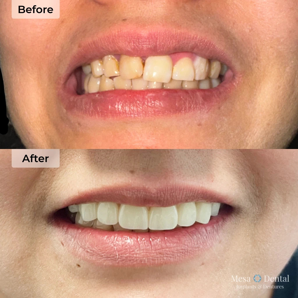 Francisca before and after dental implants in Mesa, AZ