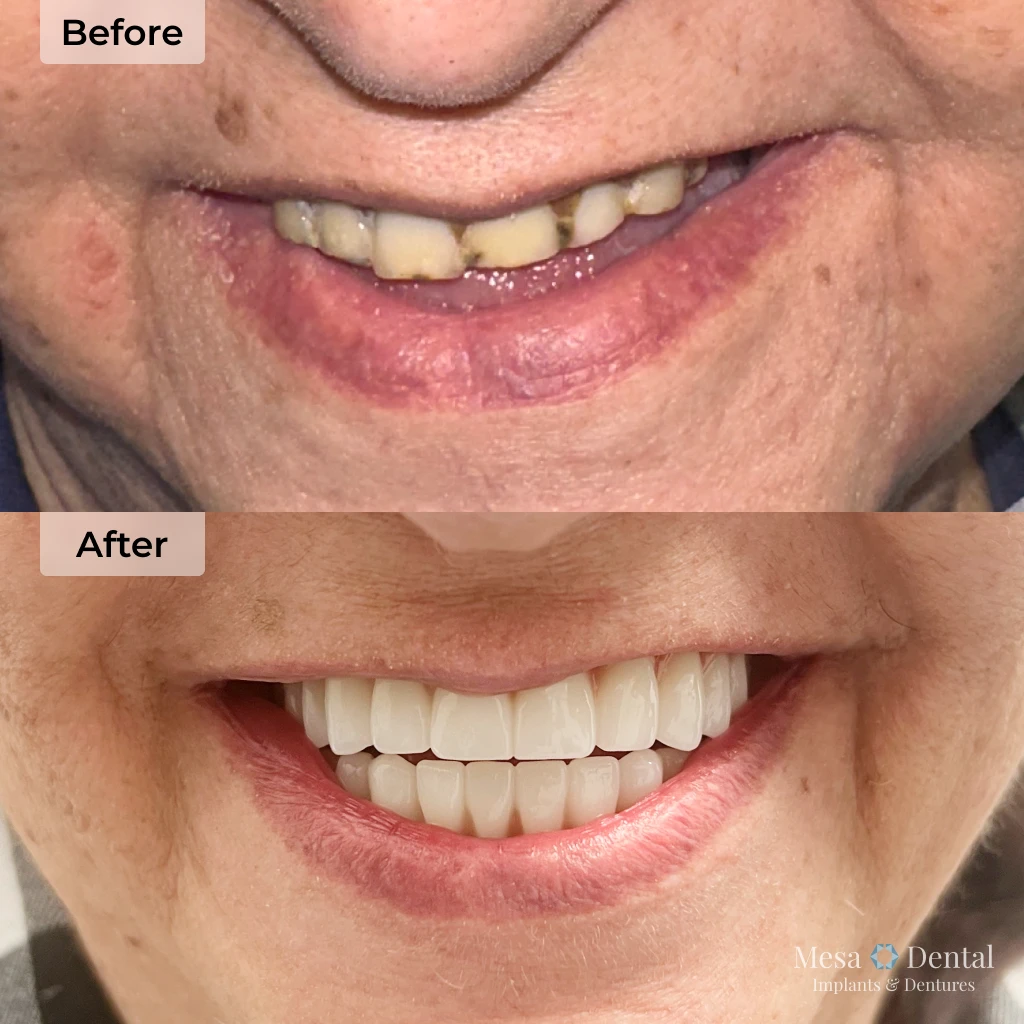Judy before and after dental implants in Mesa, AZ