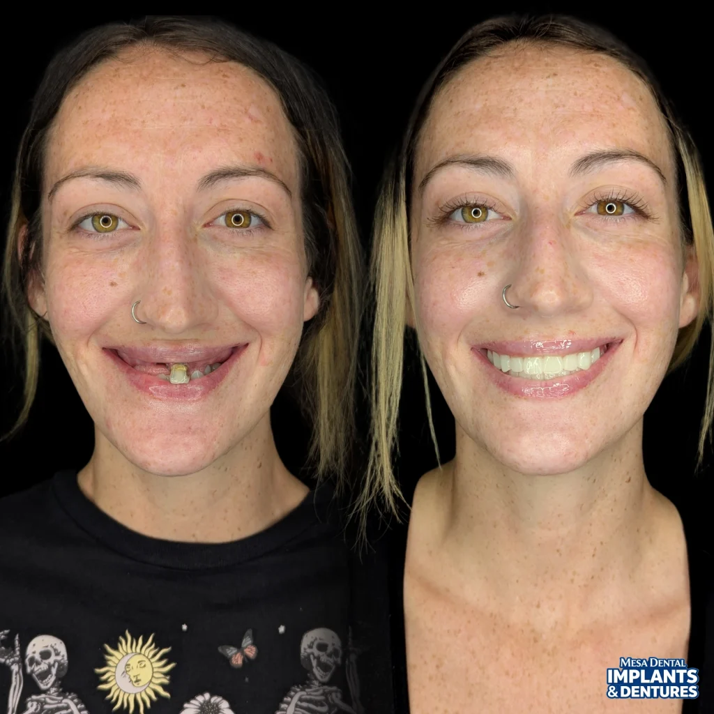 Adalyn before and after All-On-4 dental implants in Mesa at Mesa Dental Implants & Dentures