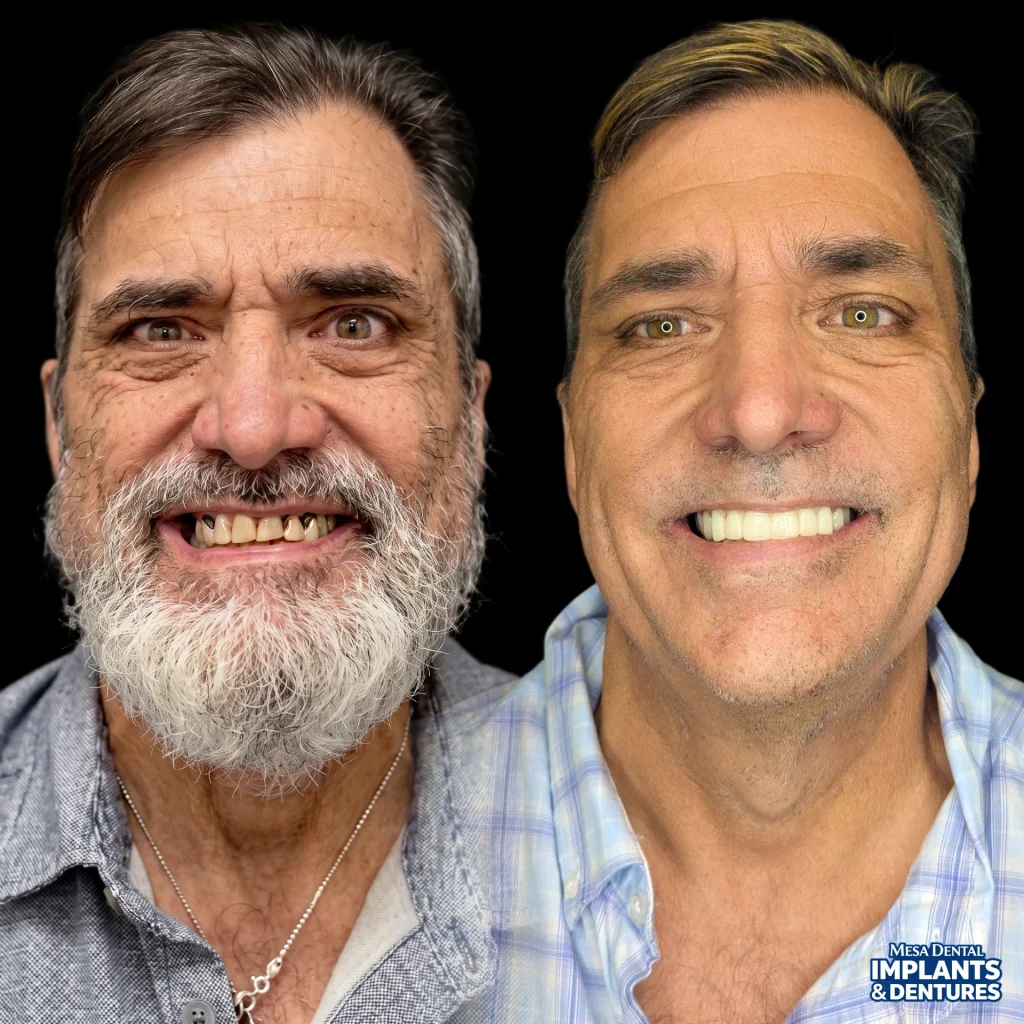 Brian before and after All-On-4 dental implants in Mesa at Mesa Dental Implants & Dentures
