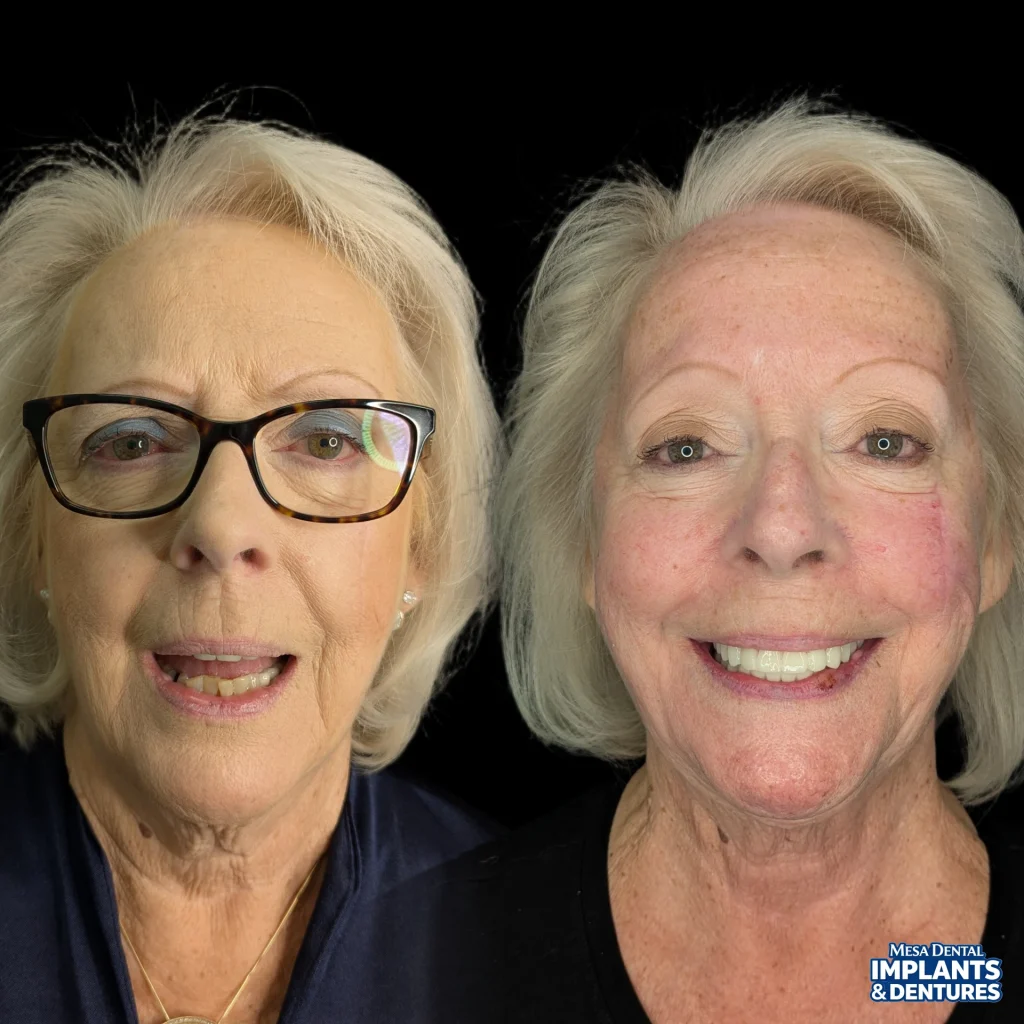 Cheryl before and after All-On-4 dental implants in Mesa at Mesa Dental Implants & Dentures
