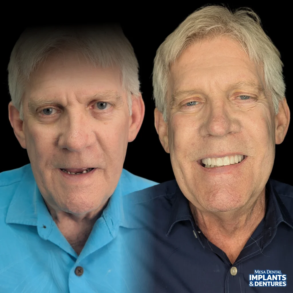 Peter before and after All-On-4 dental implants in Mesa at Mesa Dental Implants & Dentures
