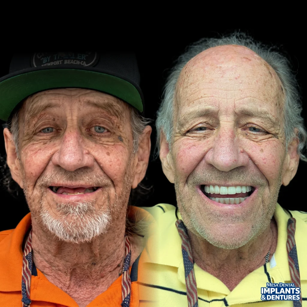 Skip before and after All-On-4 dental implants in Mesa at Mesa Dental Implants & Dentures