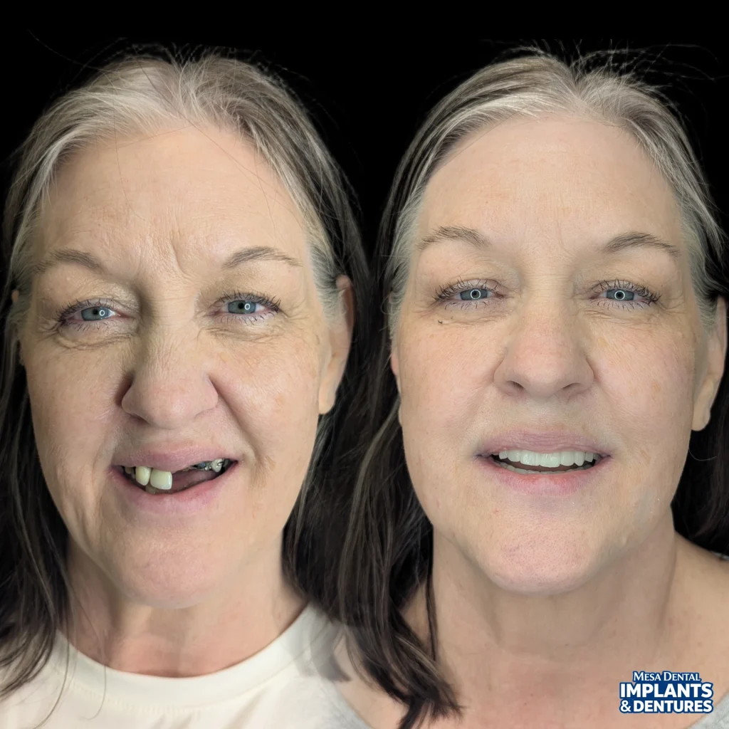 Stephanie before and after All-On-4 dental implants in Mesa at Mesa Dental Implants & Dentures