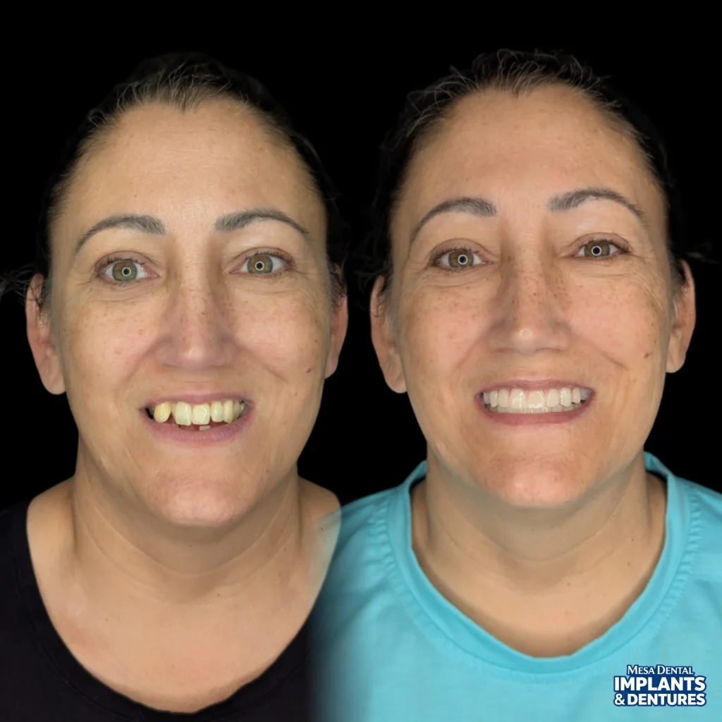 Patient before and after All-On-4 dental implants in Mesa at Mesa Dental Implants & Dentures
