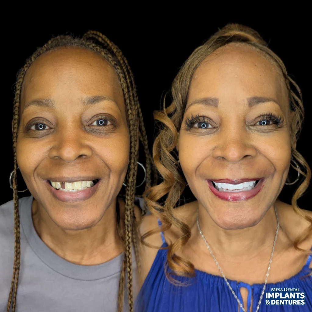 Patient before and after All-On-4 dental implants in Mesa at Mesa Dental Implants & Dentures