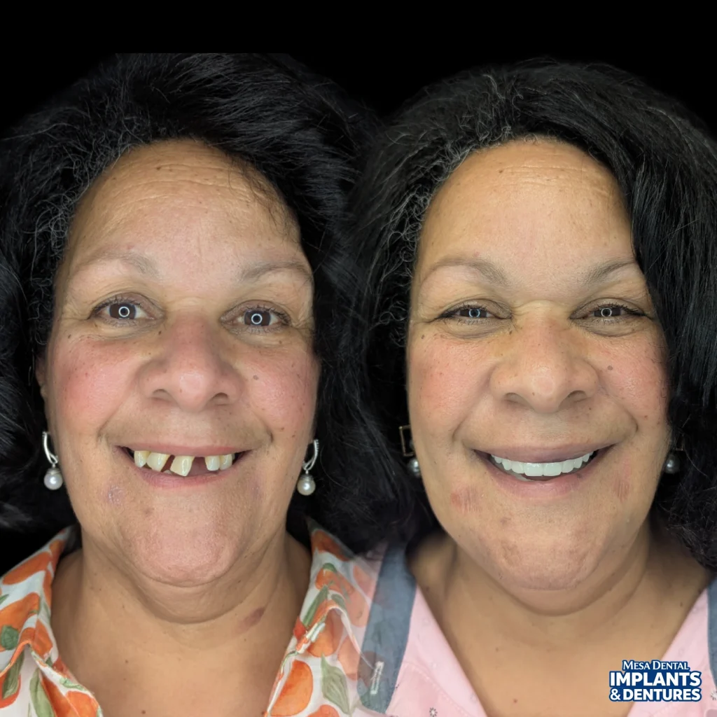 Patient before and after All-On-4 dental implants in Mesa at Mesa Dental Implants & Dentures